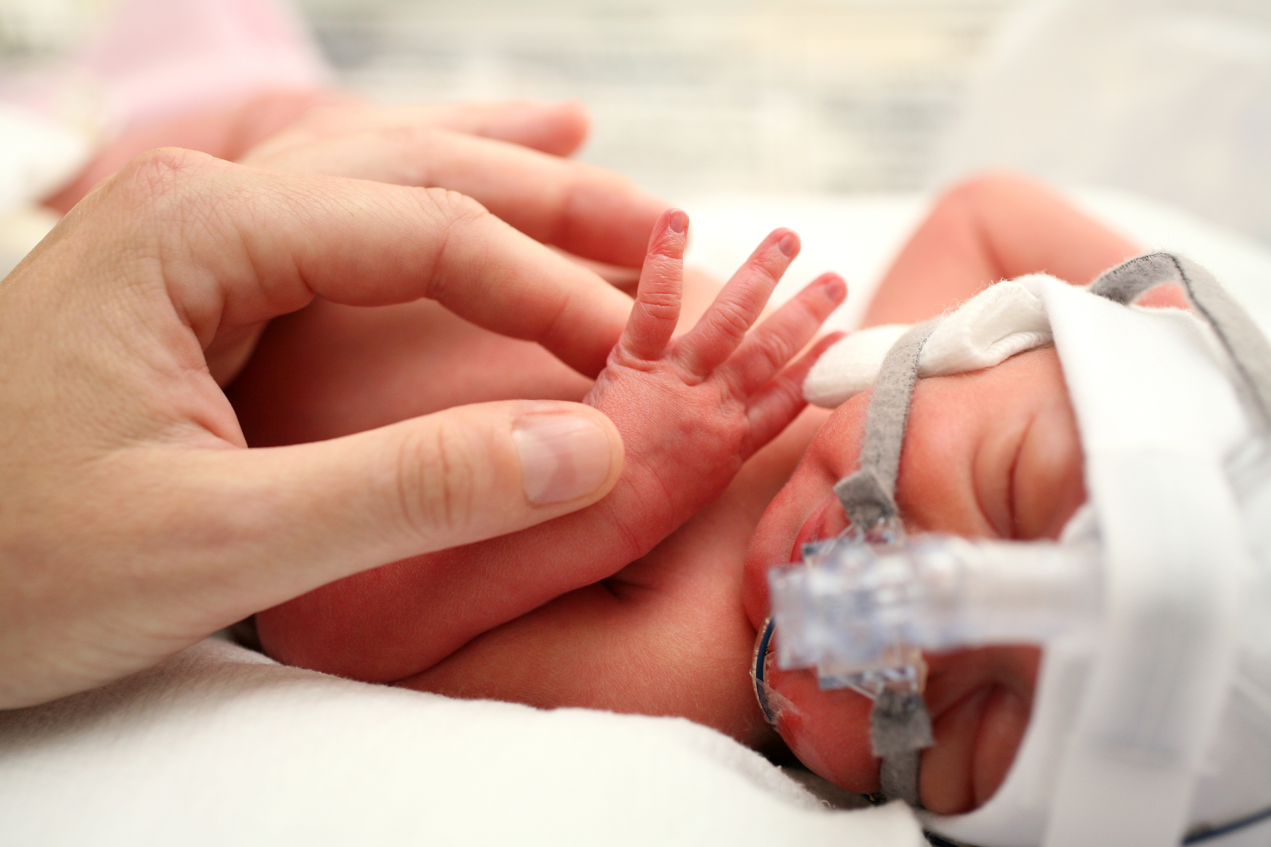 Недоношенные дети роды. Ногти недоношенного ребенка. Новорожденные с экстремально низкой массой тела. Экстремально низкая масса тела новорожденного.