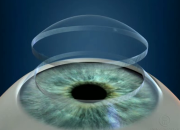 Corneal Transplants