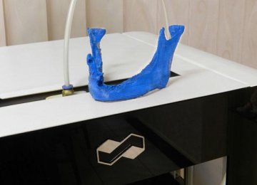 First Maxillofacial Surgery With 3D Printer in Iran