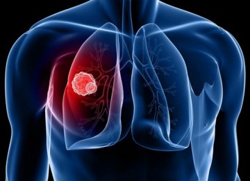 Biomarker of Early Lung Cancer Identified