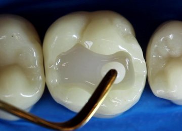 Natural Tooth Repair Method