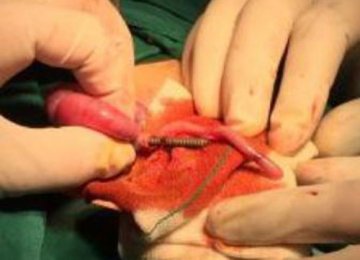 Metal Pin Removed From Baby’s Intestine