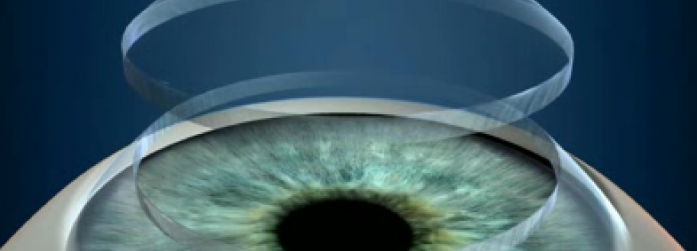 Corneal Transplants