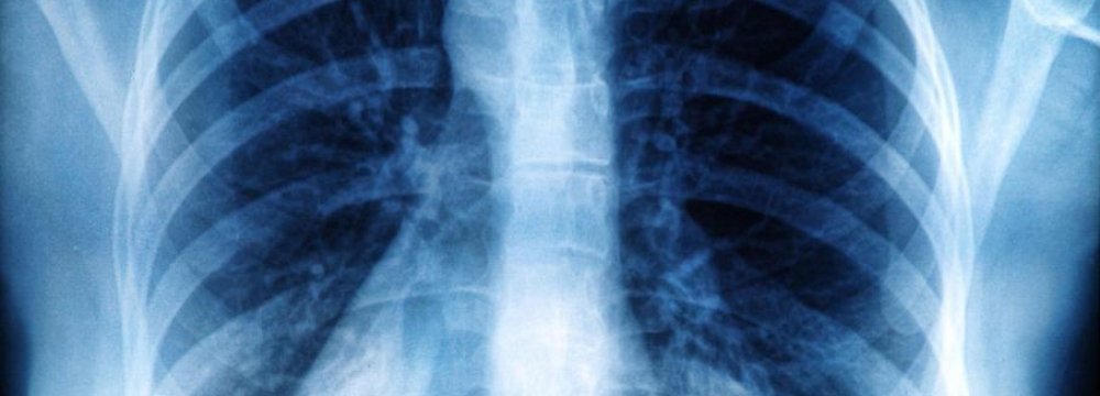 New Discovery May Stop Breast Cancer Spread to Bones