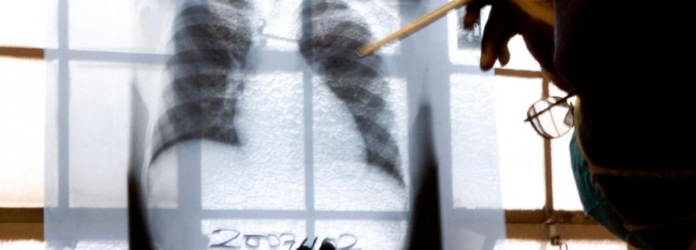 Concern Over Drug-Resistant TB 