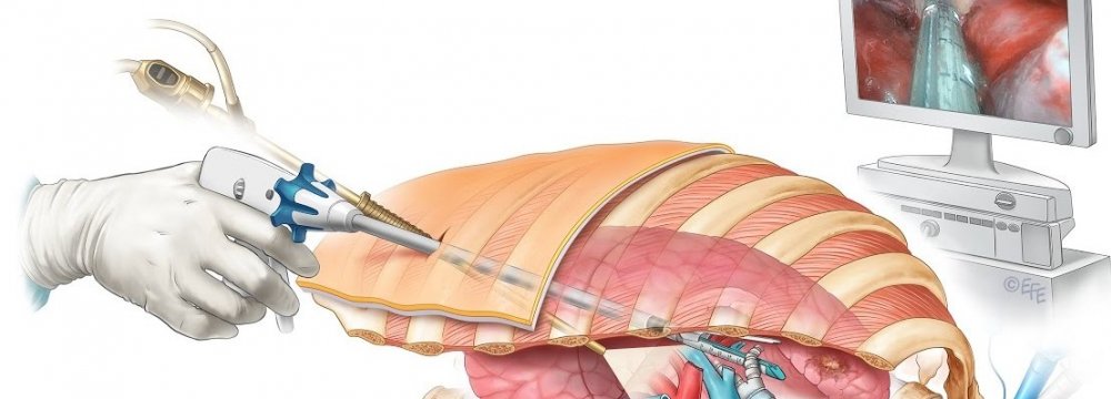 Brachytherapy Radiation  Implants for Cancer Patients 