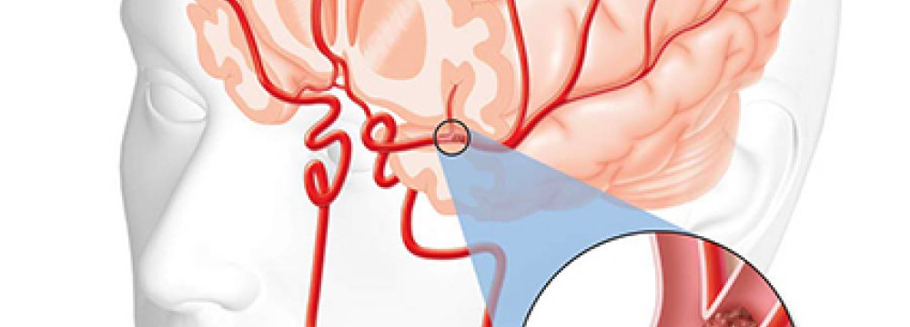 Treatable Stroke