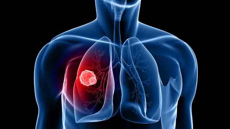 Lung Diseases Claiming More lives | Financial Tribune