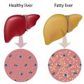 Fatty Liver Disease